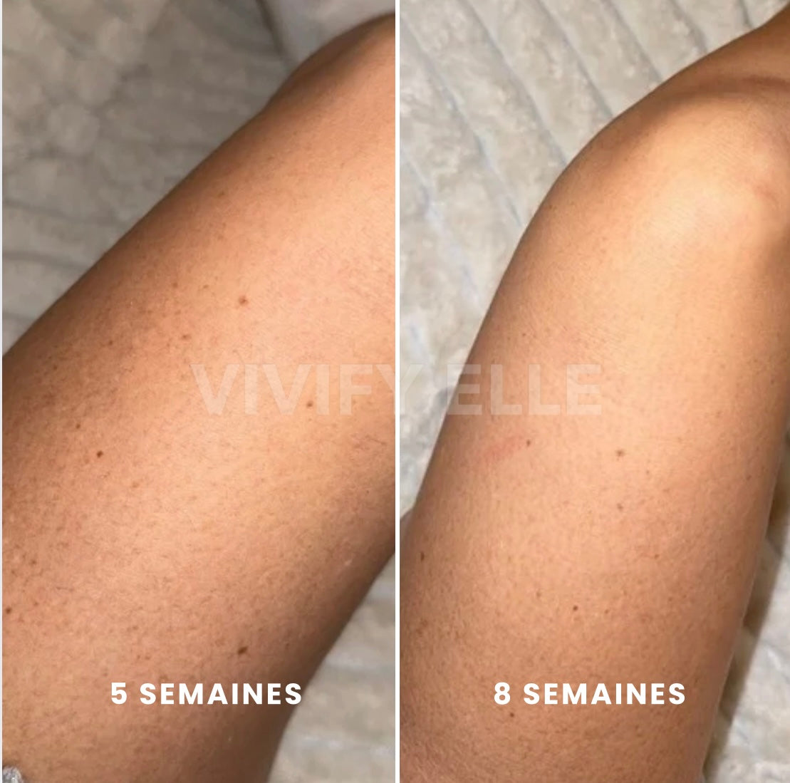 MelaGlow - Épilateur IPL adapté aux peaux claires à foncées